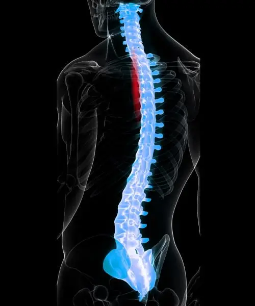 image of Subacute spinal cord injury